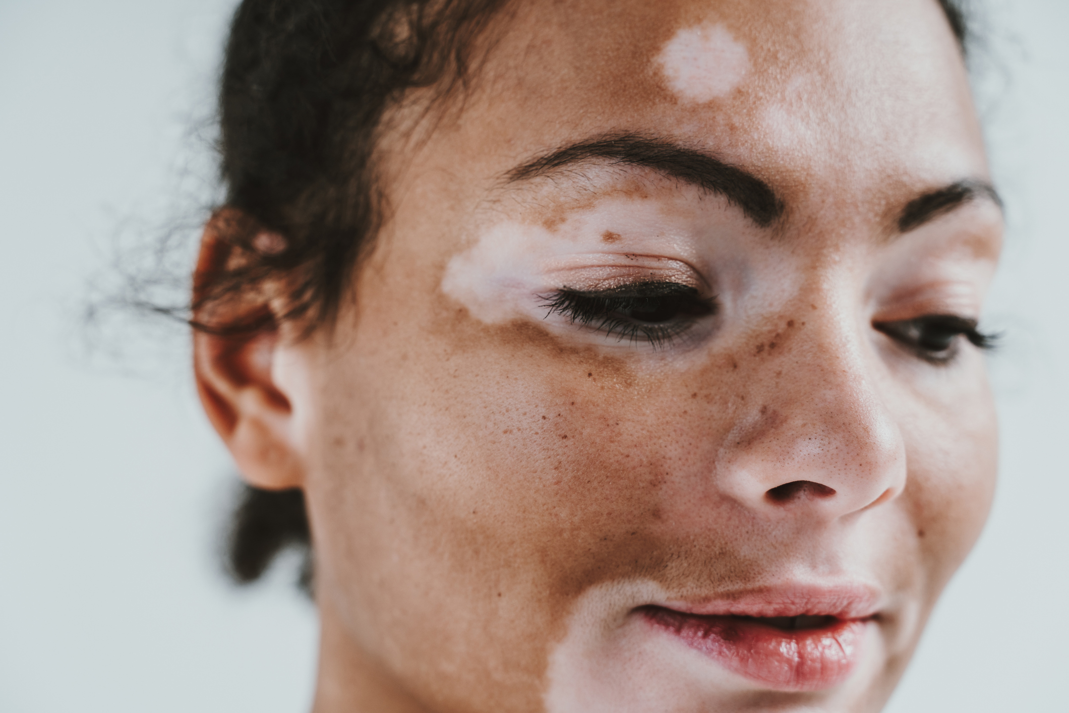 žena s vitiligom